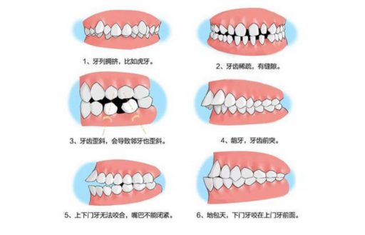 日本松风补牙多少钱一颗（日本gc树脂补牙价格）(图1)